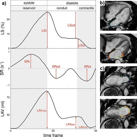 lv function afib|diagram of left atrial function.